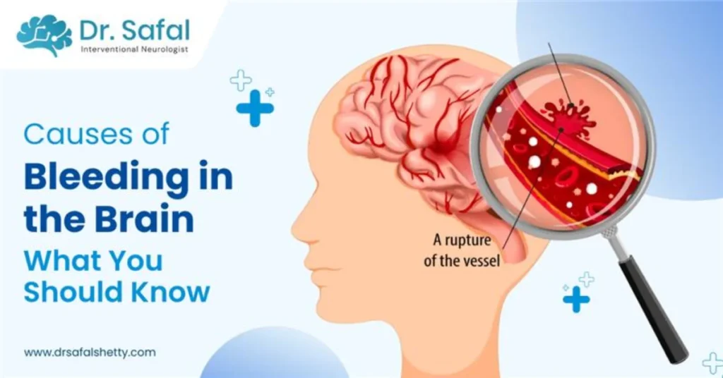 Causes of Bleeding in the Brain  What You Should Know