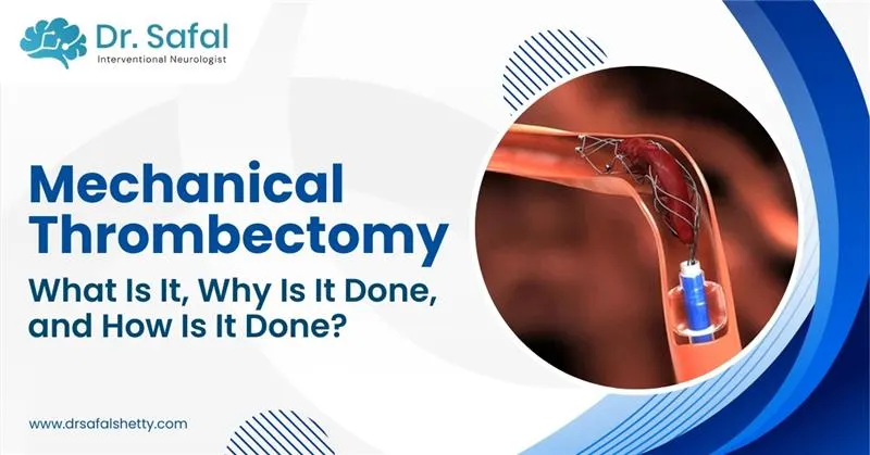 What Is Mechanical Thrombectomy? Advanced Stroke Treatment Explained