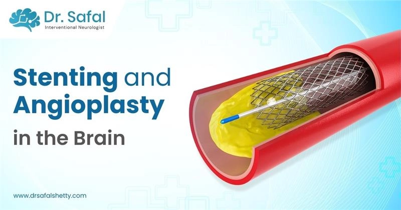 Stenting and Angioplasty in the Brain